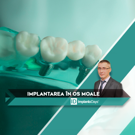 IMPLANTAREA ÎN OS MOALE IMPLANTAREA ÎN OS MOALE